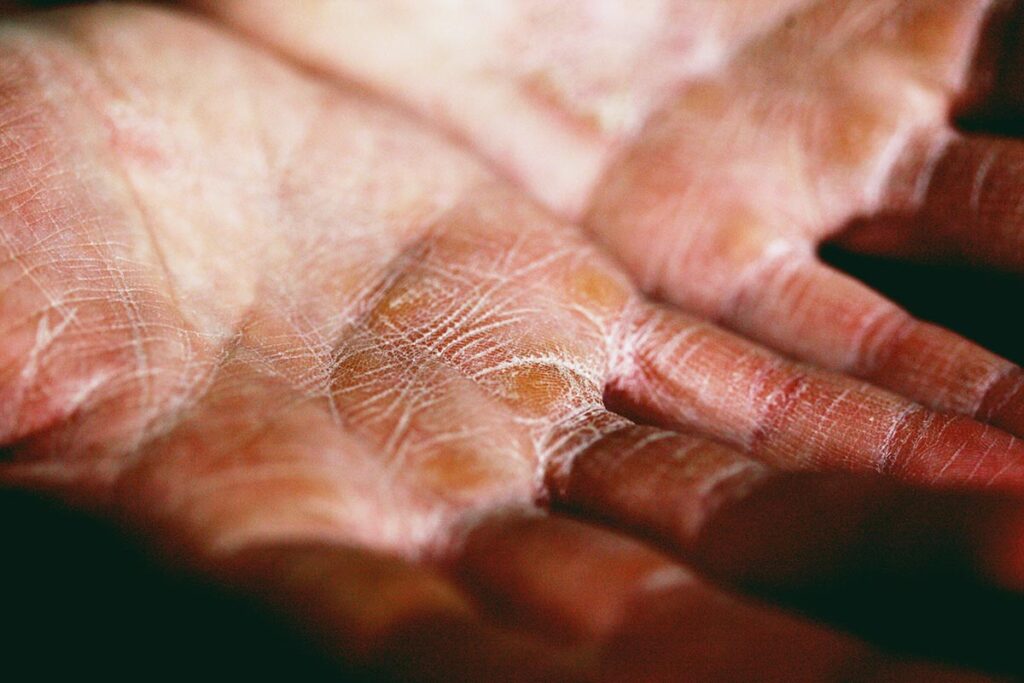 man with dry skin dehydrated because of substance abuse